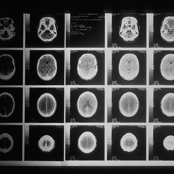 Concussionology: Update on the Science of Concussion Injury 2019